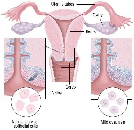 Cervical Cancer