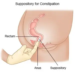 Suppository for Constipation