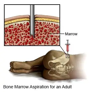 Bone Marrow Aspiration