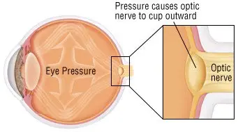 Glaucoma