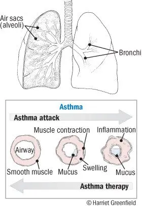 Asthma