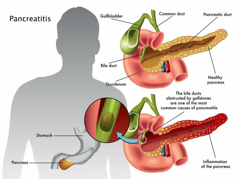 Chronic Pancreatitis