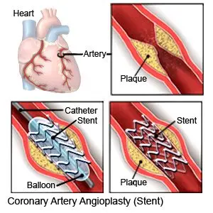 Coronary Artery Angioplasty (Stent)