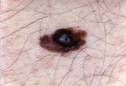 Melanoma