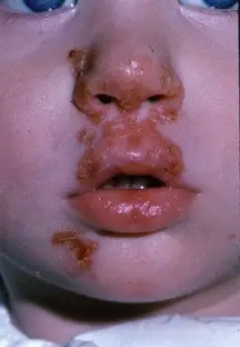 Impetigo