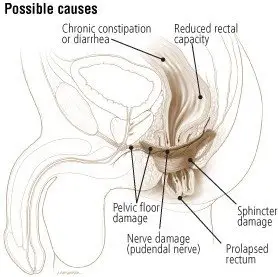 Fecal Incontinence