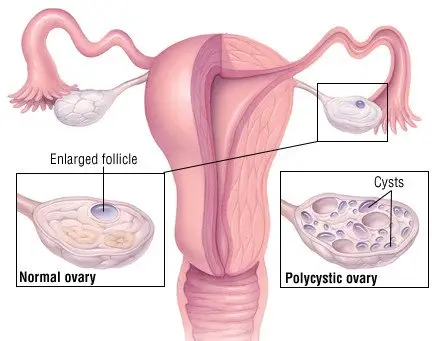 Polycystic Ovary Syndrome