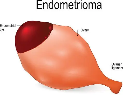 Endometriosis