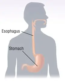 Stomach Cancer