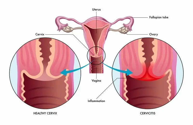 Cervicitis