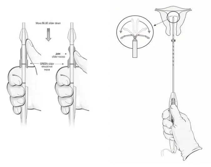 Figure 9:  Releasing and Opening the Arms of the IUS