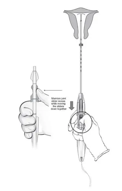 Figure 11:  Releasing LILETTA from the Inserter Tube