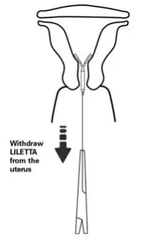 Figure 14:	 Removal of LILETTA