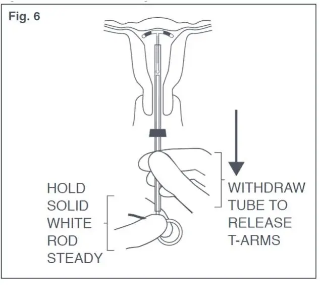 Figure 6: Release of T-Arms of Paraguard in Uterus 