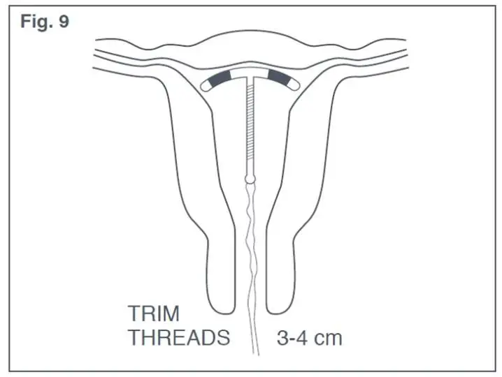 Figure 9: Appropriate Paraguard Placement in Uterus 