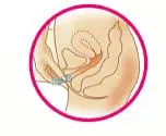 Place the tip of the ring in the vaginal opening. Use your index finger to push the folded ring gently into your vagina. Push it up towards your lower back as far as you can (See Figure E).