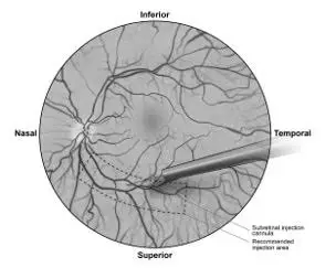 Figure 5b.  Tip of the subretinal injection cannula placed within the recommended site of injection (surgeon's point of view)