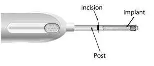 Cannula Diagram