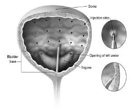 Figure 1:	Injection Pattern for Intradetrusor Injections for Treatment of Overactive Bladder and Detrusor Overactivity associated with a Neurologic Condition