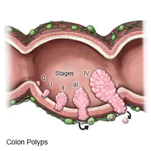 Colon Polyps