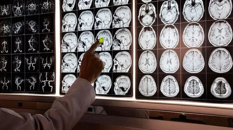 A doctor looking at an MRI film of the brain and pointing at an image