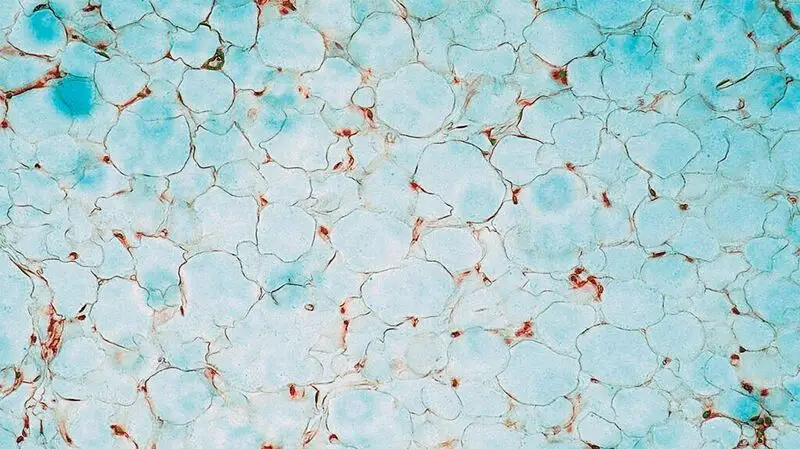 Human fat cells viewed under a microscope