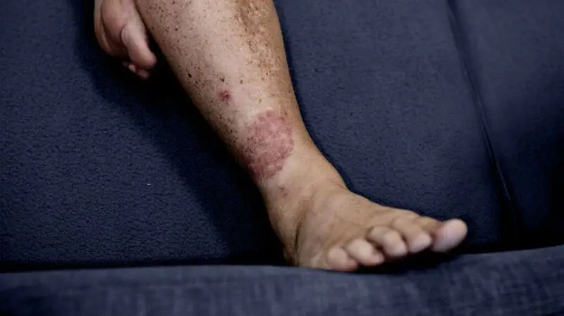 A psoriasis rash on a leg