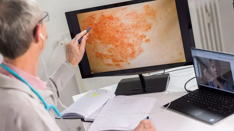 A doctor examines a psoriasis rash on a computer screen
