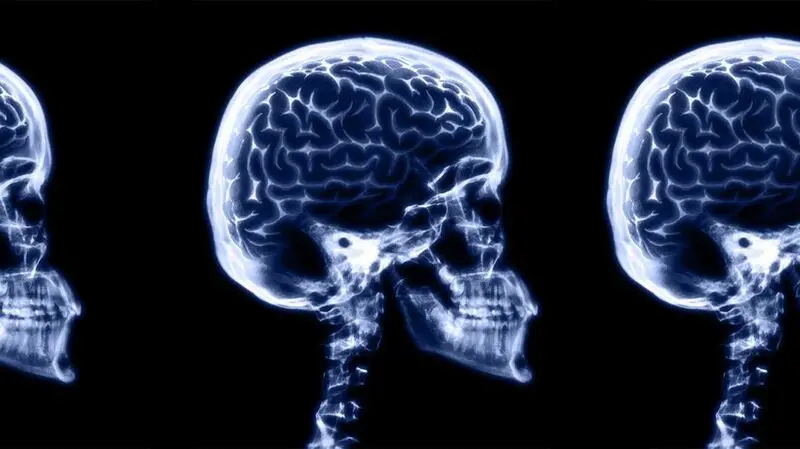 An MRI of the human brain and skull