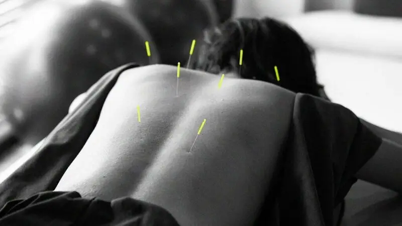 colour pop photo showing acupuncture needles on a person's back