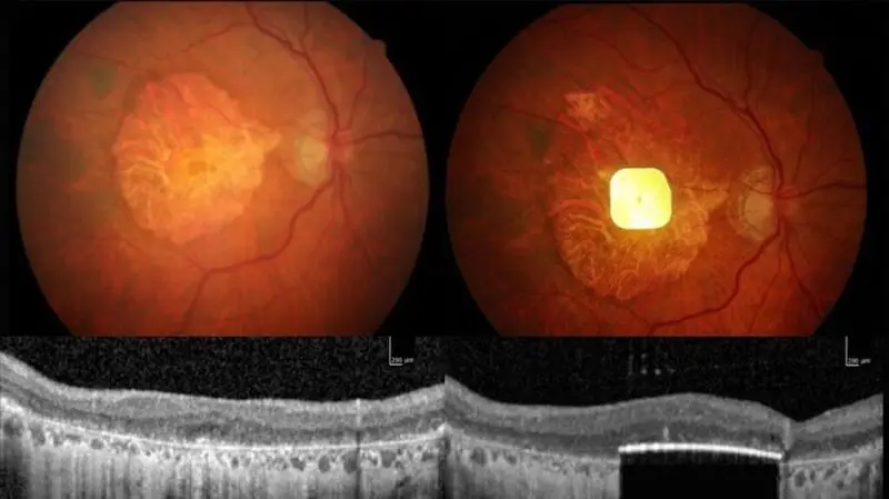 The scans of a retinal implant placed in a pair of eyes diagnosed with macular degeneration