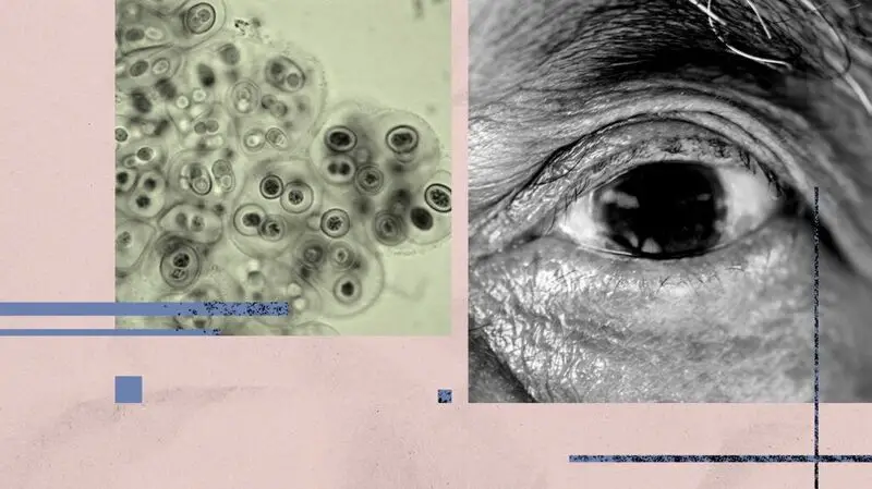 A collage of photos of the bacteria Chlamydia pneumoniae and a human eye to depict its link to Alzheimer's