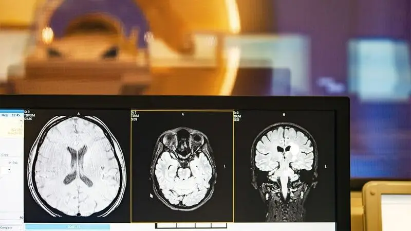 A tomography brain scan to check for memory loss related changes on a hospital computer screen