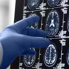 Dementia: Neurovascular, metabolic changes may predict progression