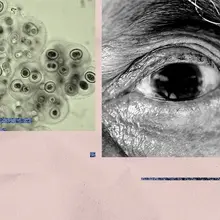 Alzheimer's: Common bacteria found in eye linked to increased risk