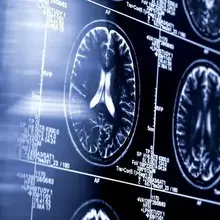 AI-driven stroke tool shows improved outcomes in major clinical trial
