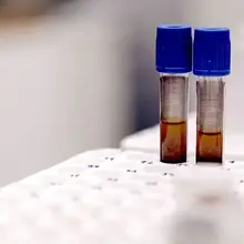 Anemia may increase the risk of dementia by as much as 66%