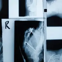 Type 2 diabetes: Semaglutide may help protect bone health