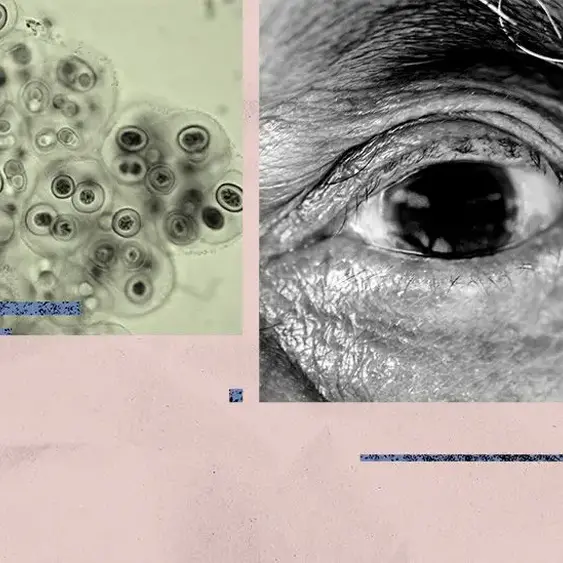 Alzheimer's: Common bacteria found in eye linked to increased risk