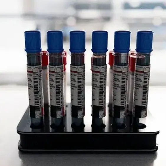 Rarely used cholesterol test may prevent more strokes, heart attacks