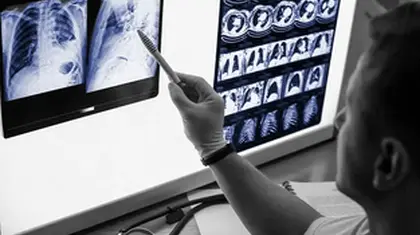 Lung cancer: CT scan screenings can vastly improve long-term survival