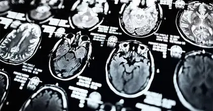 Parkinson's disease: How MRI scans can help with diagnosis, treatments