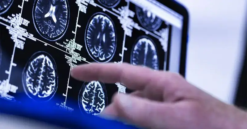 Dementia: Novel brain scan may predict age-related disease