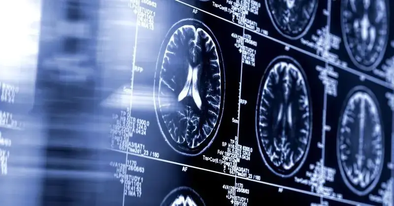 AI-driven stroke tool shows improved outcomes in major clinical trial